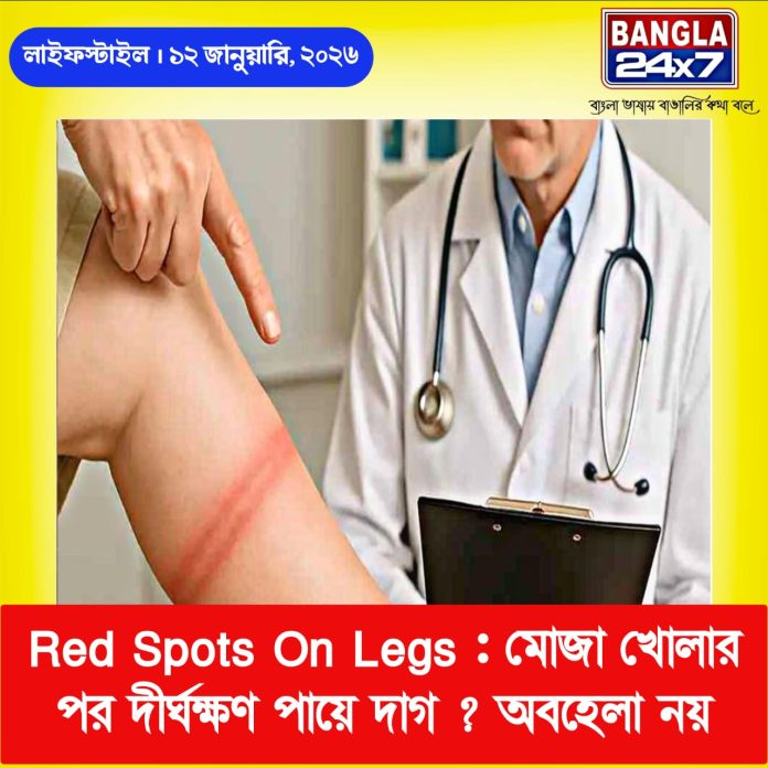 Red Spots On Legs : মোজা খোলার পর দীর্ঘক্ষণ পায়ে দাগ? অবহেলা নয়